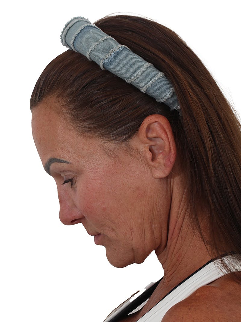 Laser Treatment Before & After Gallery - Patient 357981 - Image 7