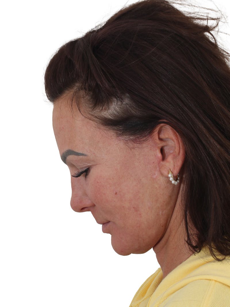 Skin Resurfacing Before & After Gallery - Patient 357981 - Image 8