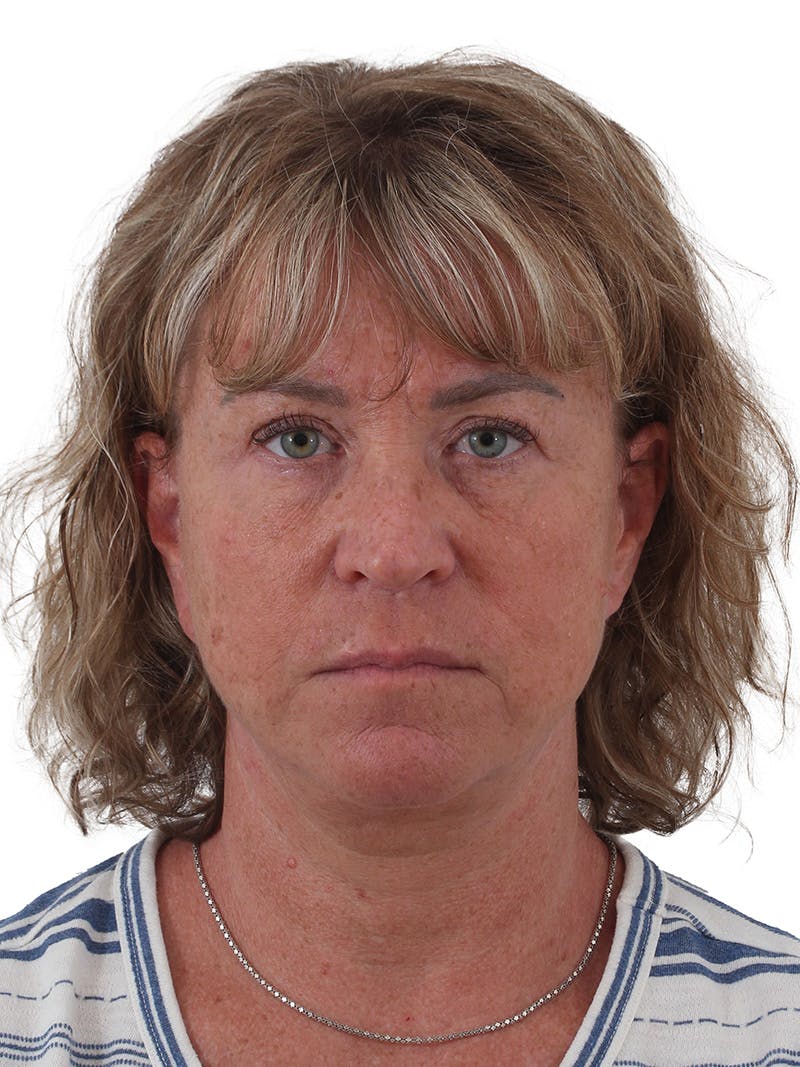 Facelift/Neck Lift Before & After Gallery - Patient 210037 - Image 3