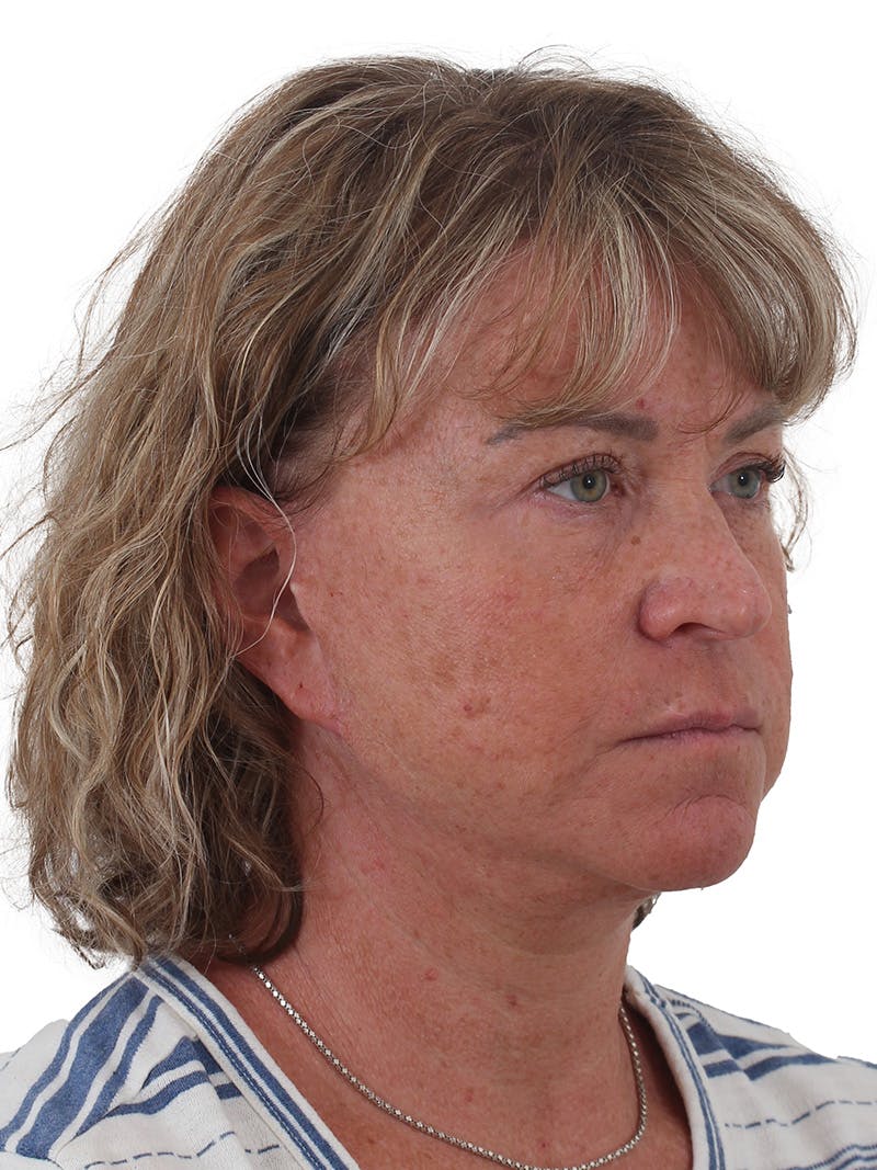 Facelift/Neck Lift Before & After Gallery - Patient 210037 - Image 3