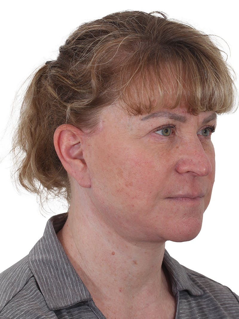 Facelift/Neck Lift Before & After Gallery - Patient 210037 - Image 2