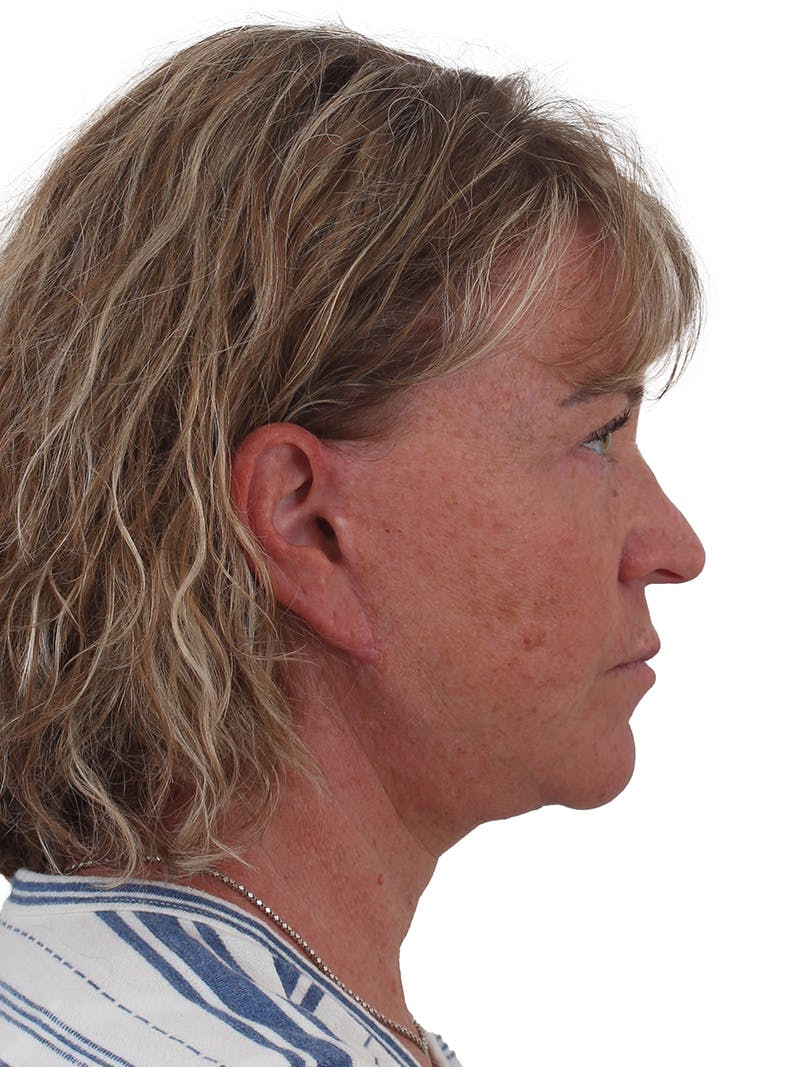 Facelift/Neck Lift Before & After Gallery - Patient 210037 - Image 5