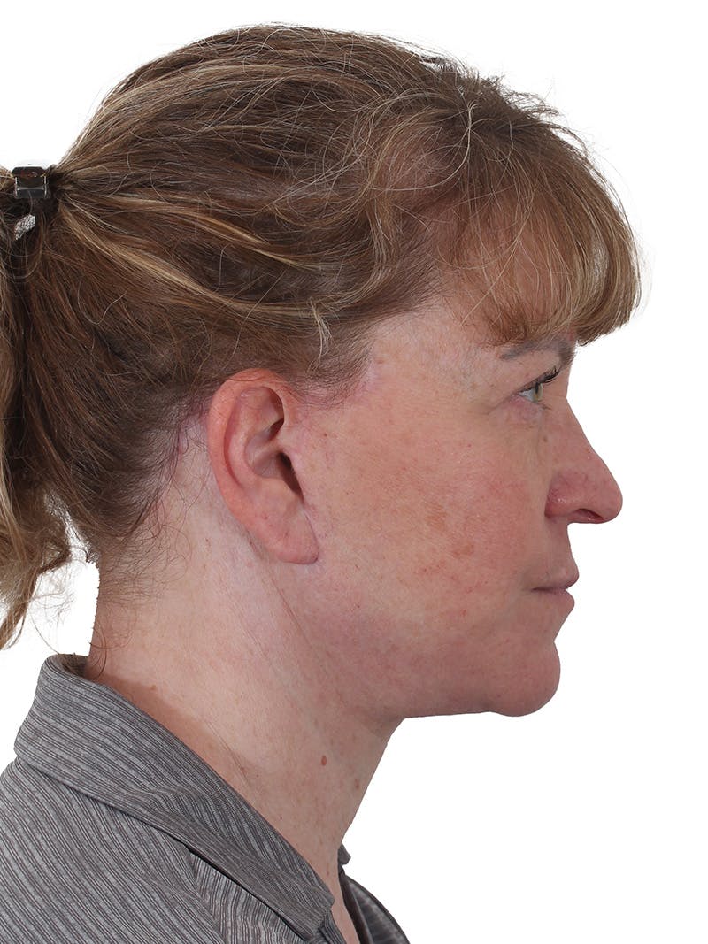 Facelift/Neck Lift Before & After Gallery - Patient 210037 - Image 6