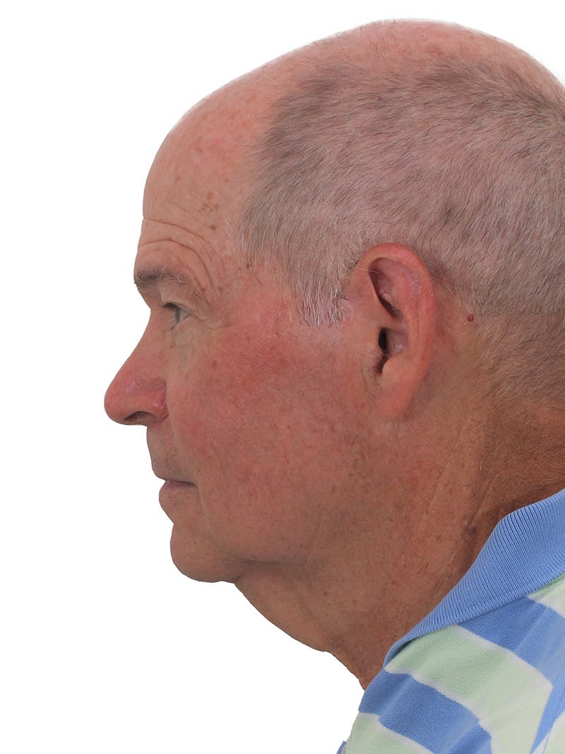Facelift/Neck Lift Before & After Gallery - Patient 752765 - Image 5