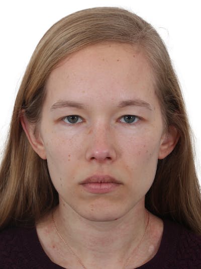 Blepharoplasty Before & After Gallery - Patient 422414 - Image 1