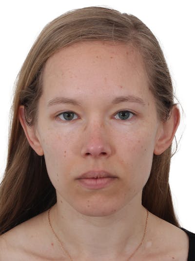 Blepharoplasty Before & After Gallery - Patient 422414 - Image 2
