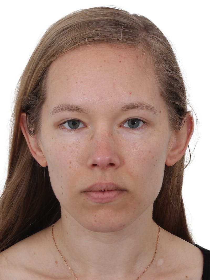Blepharoplasty Before & After Gallery - Patient 422414 - Image 2