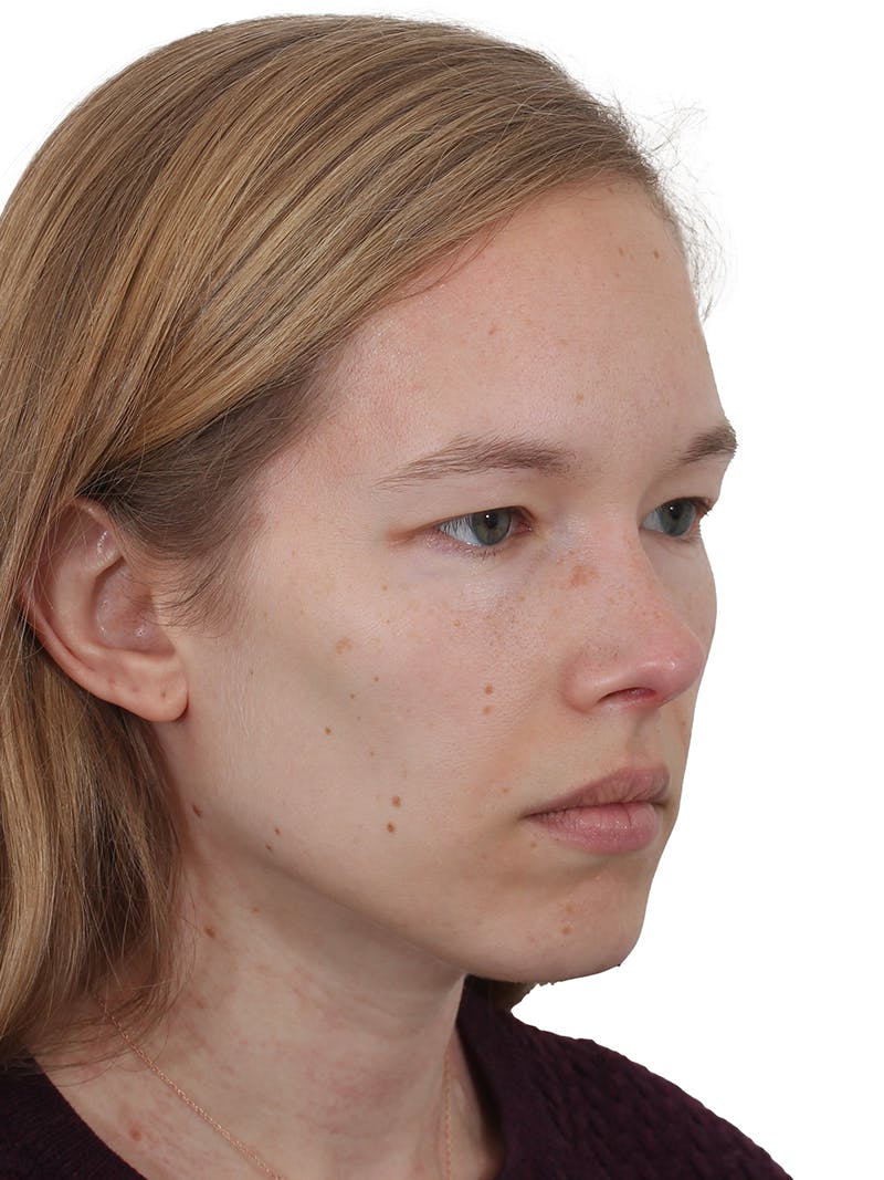 Blepharoplasty Before & After Gallery - Patient 422414 - Image 3