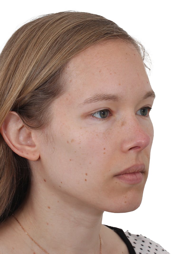 Blepharoplasty Before & After Gallery - Patient 422414 - Image 4