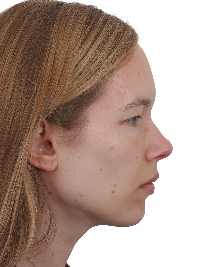 Blepharoplasty Before & After Gallery - Patient 422414 - Image 5