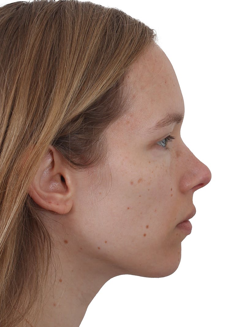 Blepharoplasty Before & After Gallery - Patient 422414 - Image 6