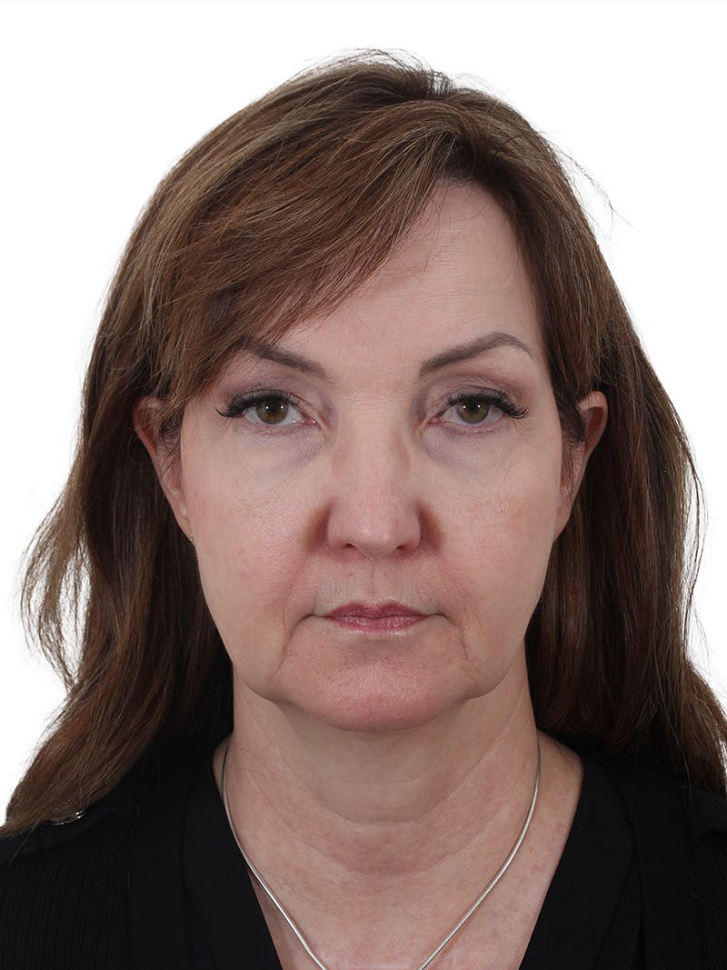 Dr. Frankel’s Facelift in Cleveland Before and After 06