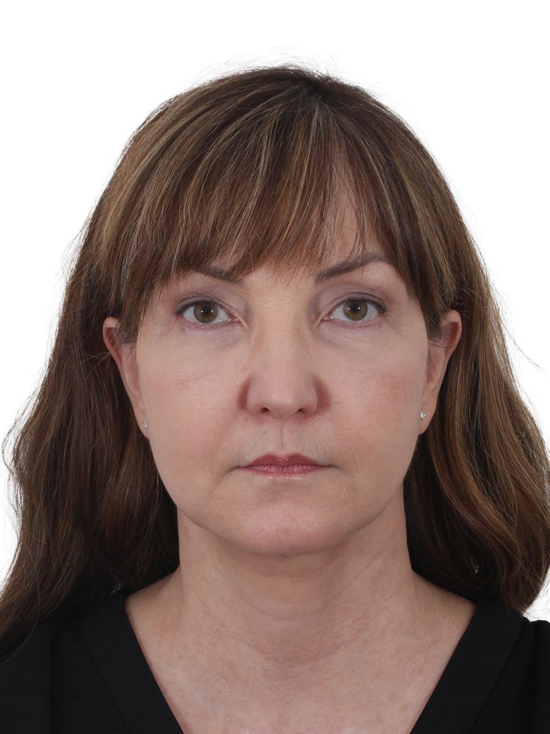 Dr. Frankel’s Facelift in Cleveland Before and After 06