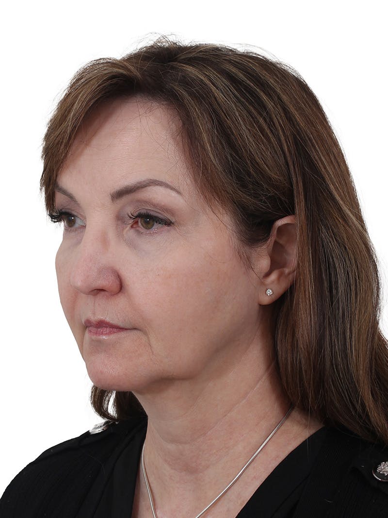 Blepharoplasty Before & After Gallery - Patient 132965 - Image 3
