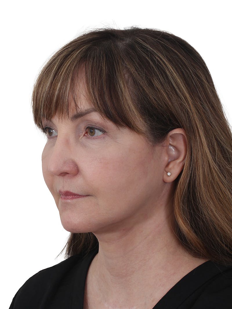 Blepharoplasty Before & After Gallery - Patient 132965 - Image 4