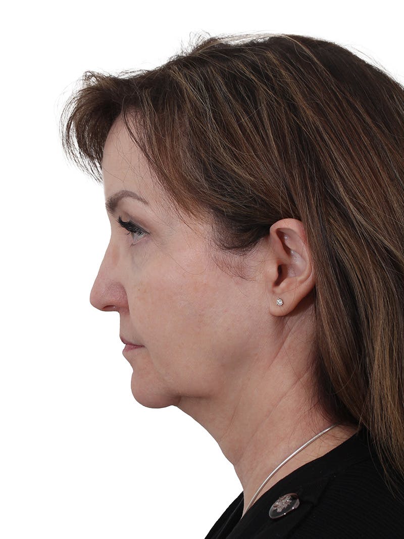 Blepharoplasty Before & After Gallery - Patient 132965 - Image 5
