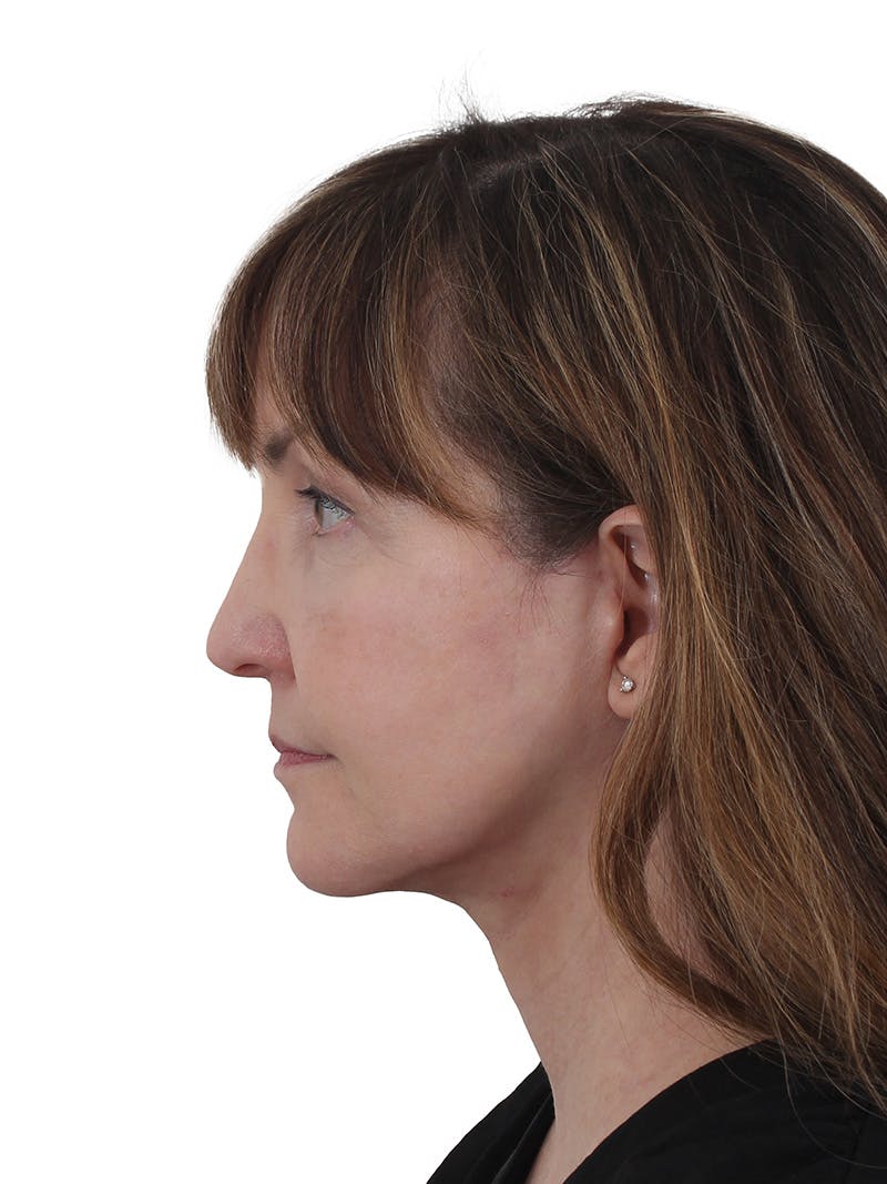 Blepharoplasty Before & After Gallery - Patient 132965 - Image 6