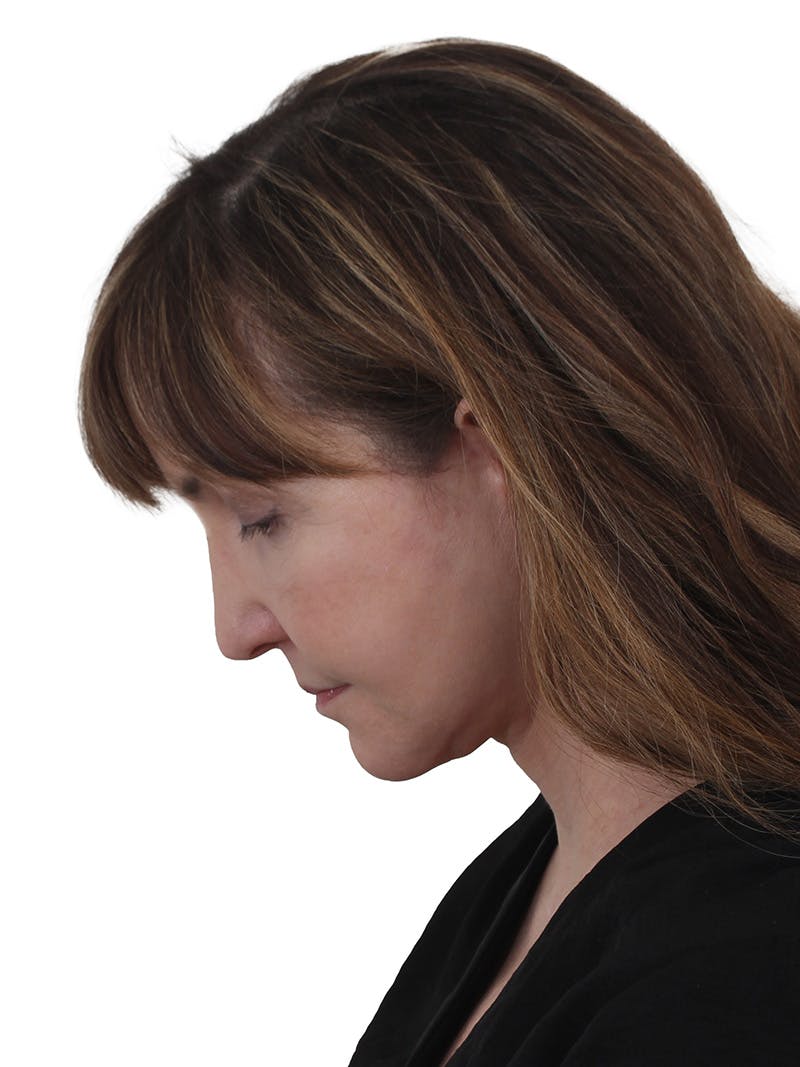 Blepharoplasty Before & After Gallery - Patient 132965 - Image 8