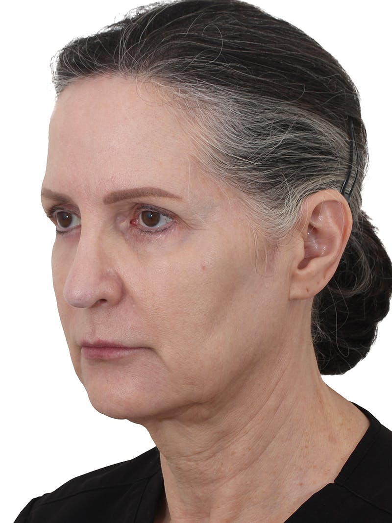 Dr. Frankel's Facelift in Cleveland Before and After 12