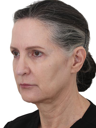 Fat Transfer Before & After Gallery - Patient 119461 - Image 1