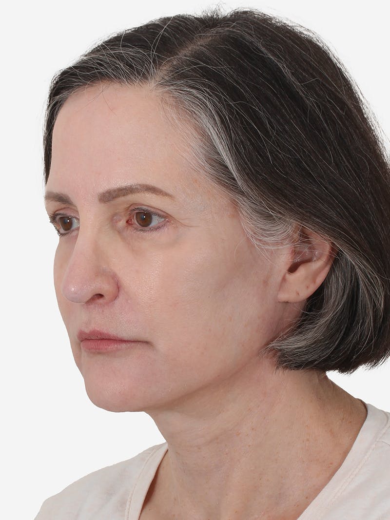 Dr. Frankel's Facelift in Cleveland Before and After 12