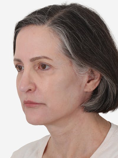 Fat Transfer Before & After Gallery - Patient 119461 - Image 2
