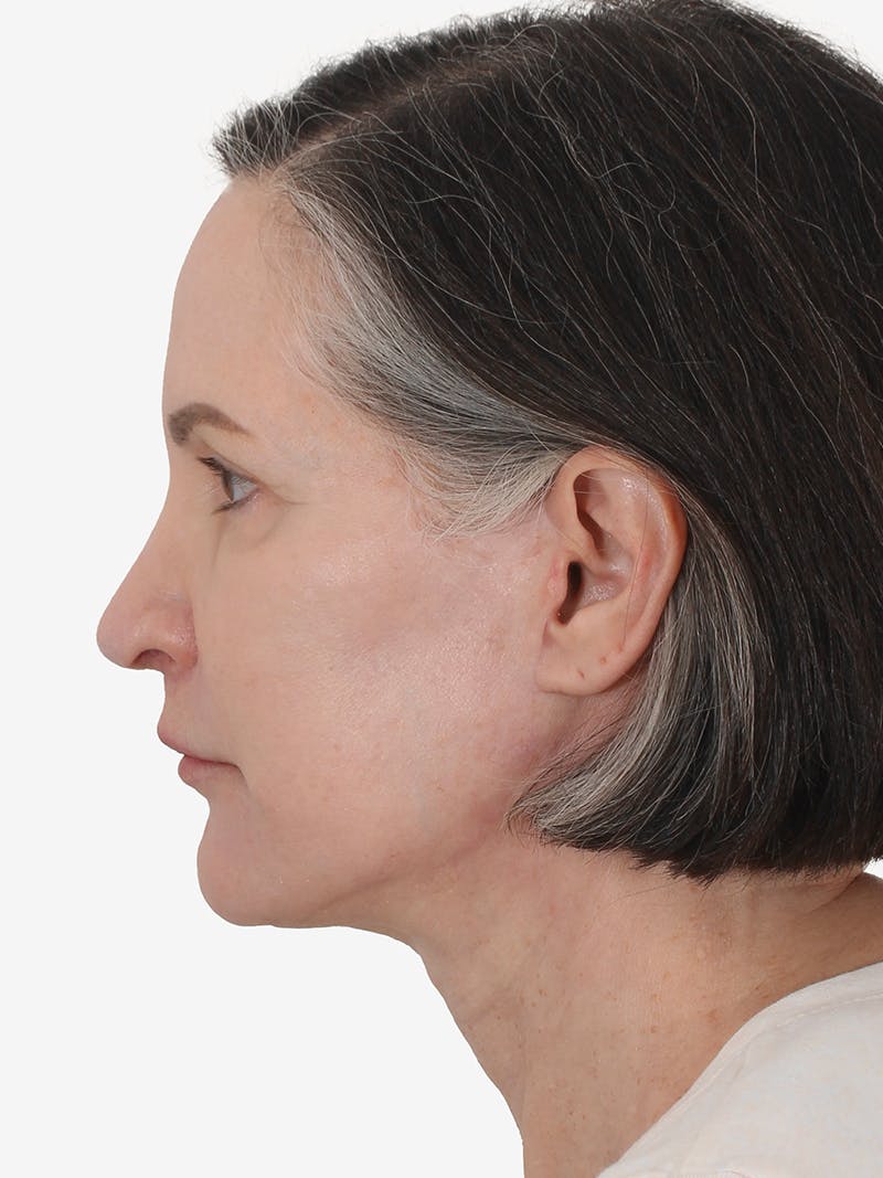 Facelift/Neck Lift Before & After Gallery - Patient 159151 - Image 4