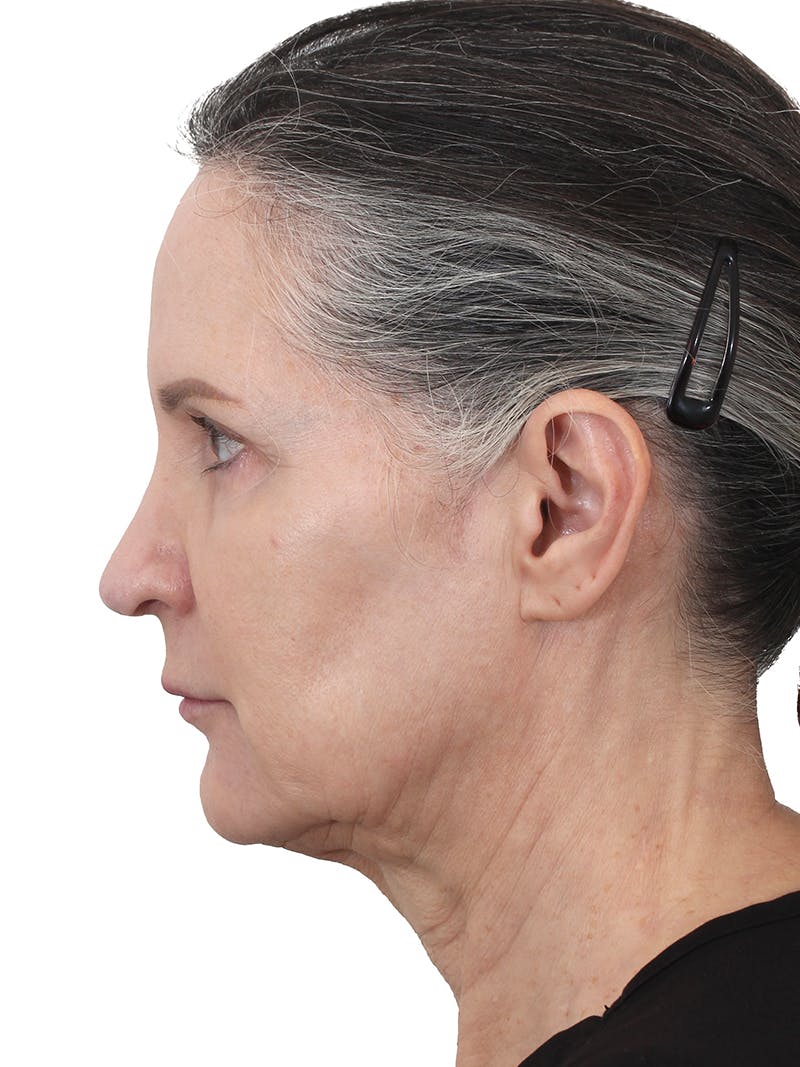 Facelift/Neck Lift Before & After Gallery - Patient 159151 - Image 3