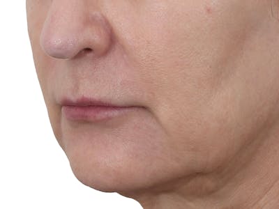 Lip Augmentation  Before & After Gallery - Patient 155714 - Image 1