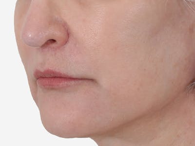 Lip Augmentation  Before & After Gallery - Patient 155714 - Image 2