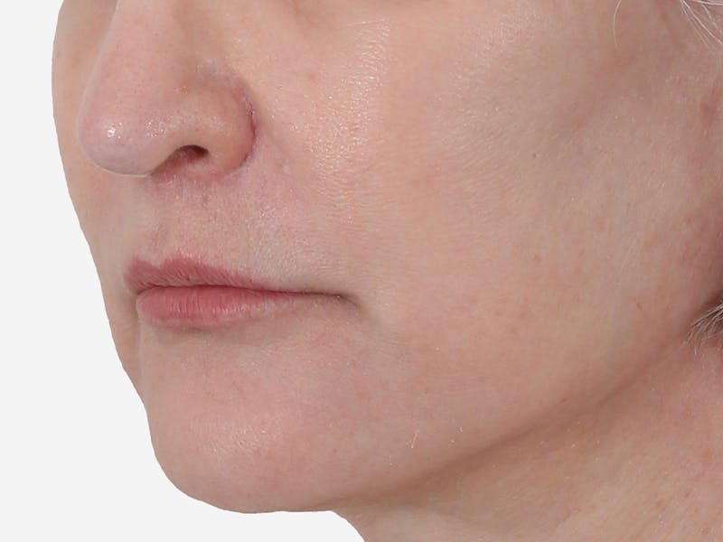 Lip Augmentation  Before & After Gallery - Patient 155714 - Image 2