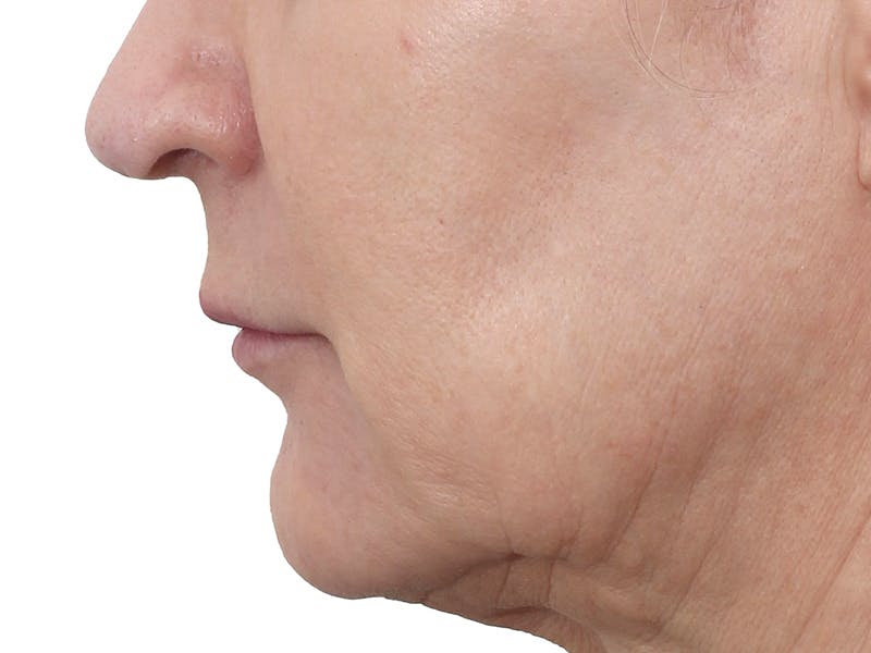 Lip Augmentation  Before & After Gallery - Patient 155714 - Image 3