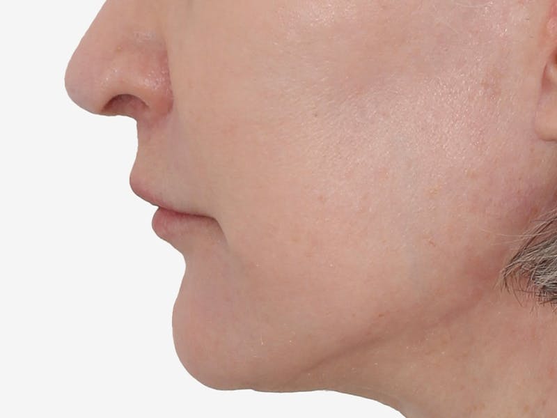 Lip Augmentation  Before & After Gallery - Patient 155714 - Image 4