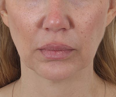 Lip Augmentation  Before & After Gallery - Patient 160881 - Image 1