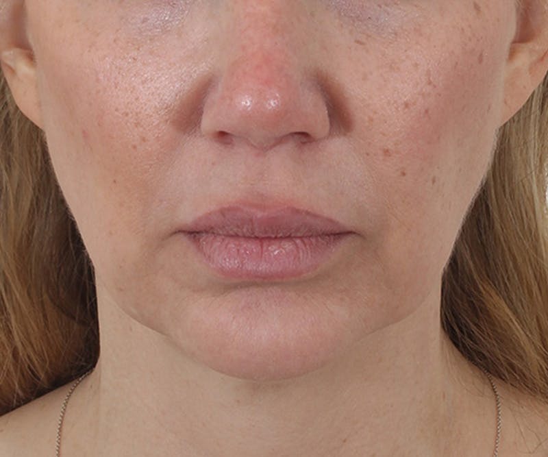 Lip Augmentation  Before & After Gallery - Patient 160881 - Image 1