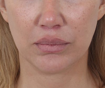 Lip Augmentation  Before & After Gallery - Patient 160881 - Image 2