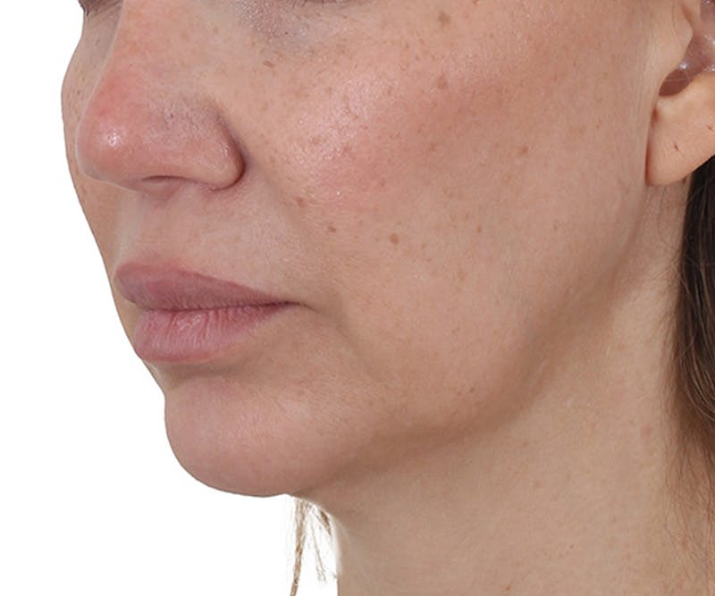 Lip Augmentation  Before & After Gallery - Patient 160881 - Image 3