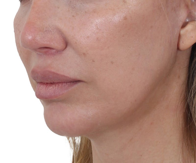 Lip Augmentation  Before & After Gallery - Patient 160881 - Image 4