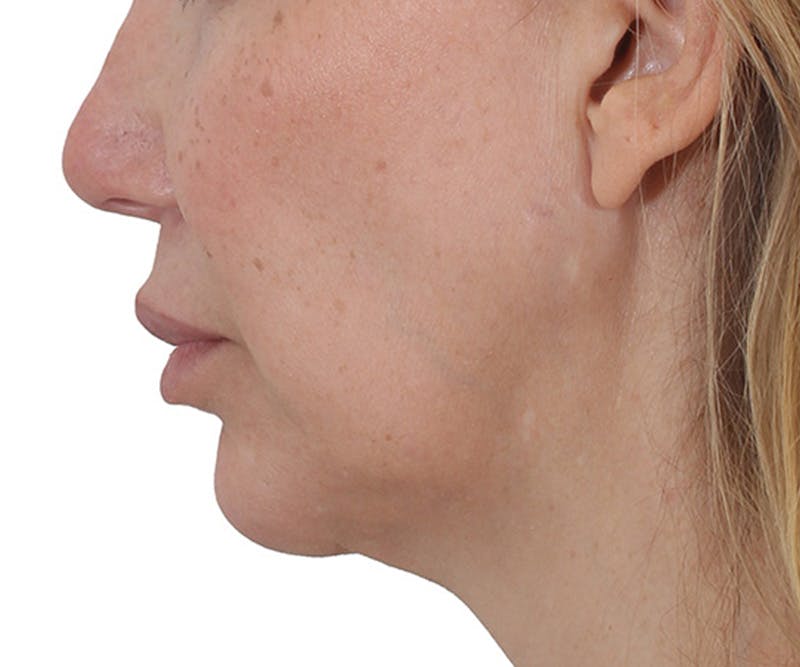 Lip Augmentation  Before & After Gallery - Patient 160881 - Image 5