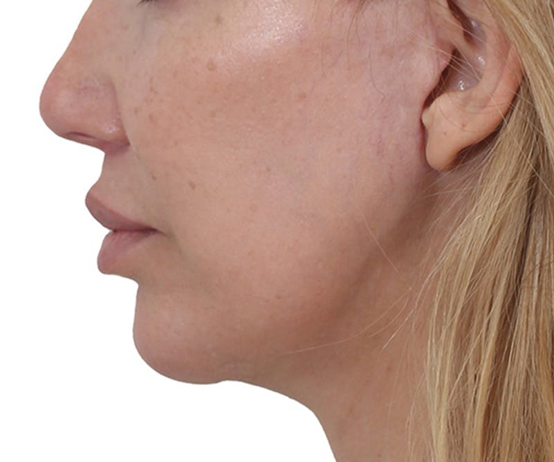 Lip Augmentation  Before & After Gallery - Patient 160881 - Image 6