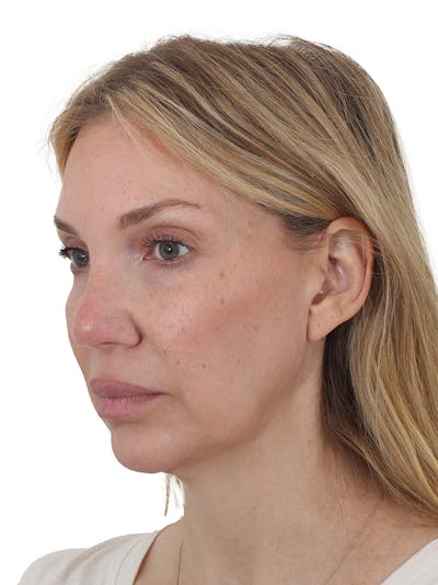 Facelift/Neck Lift Before & After Gallery - Patient 302446 - Image 1