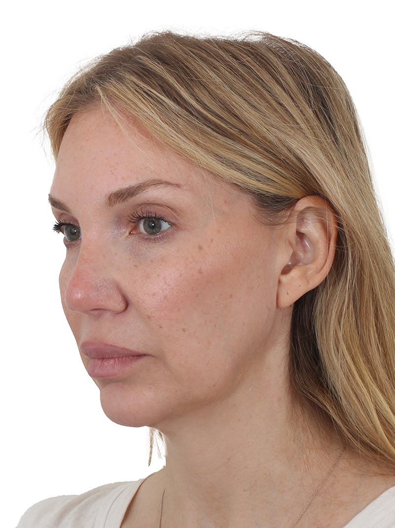 Facelift/Neck Lift Before & After Gallery - Patient 302446 - Image 1