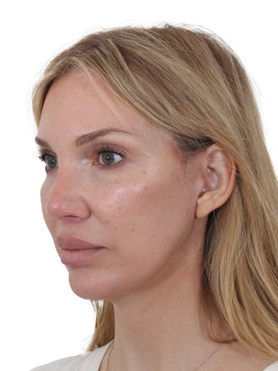 Facelift/Neck Lift Before & After Gallery - Patient 302446 - Image 2
