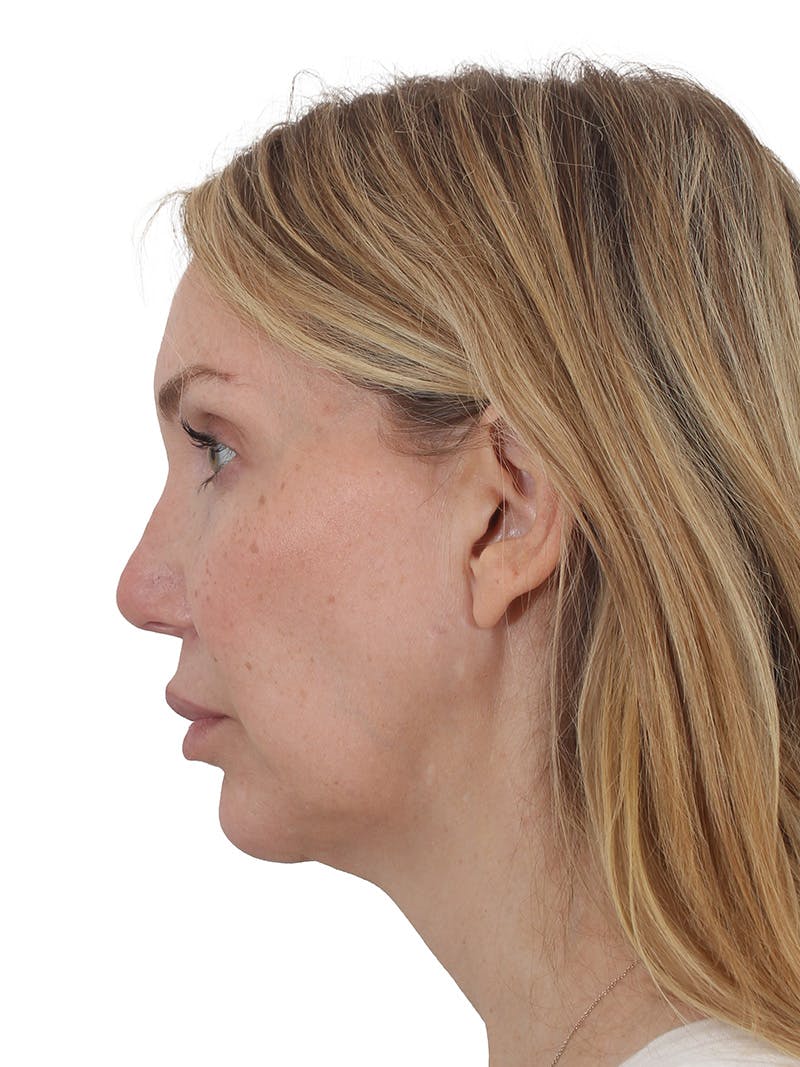 Facelift/Neck Lift Before & After Gallery - Patient 302446 - Image 3