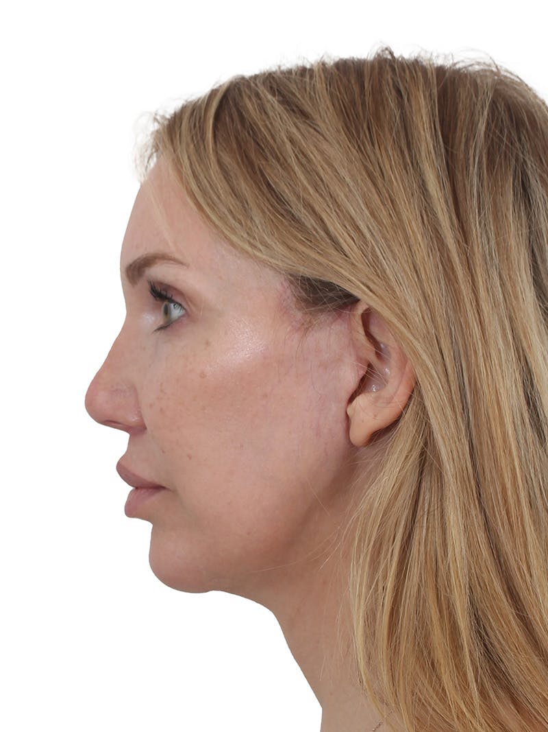 Facelift/Neck Lift Before & After Gallery - Patient 302446 - Image 4