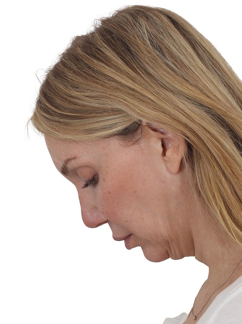 Facelift/Neck Lift Before & After Gallery - Patient 302446 - Image 5