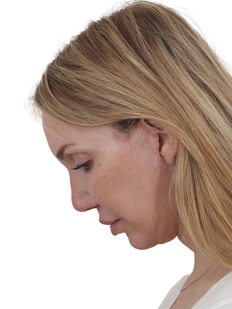 Facelift/Neck Lift Before & After Gallery - Patient 302446 - Image 6
