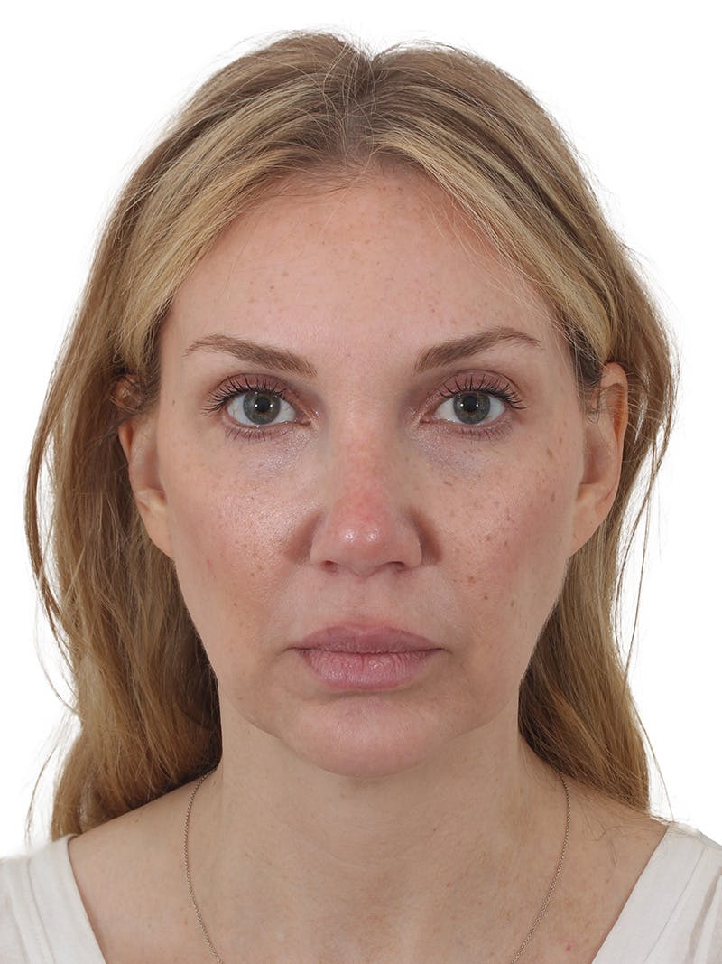 Facelift/Neck Lift Before & After Gallery - Patient 302446 - Image 7