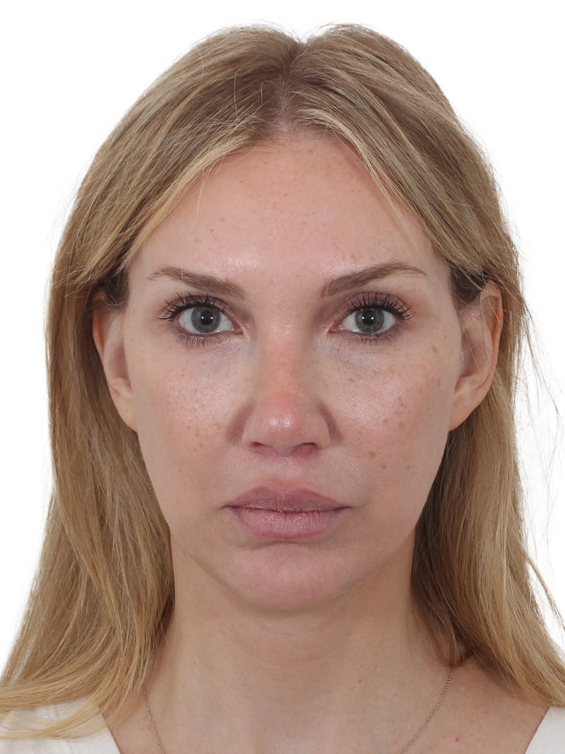 Facelift/Neck Lift Before & After Gallery - Patient 302446 - Image 8