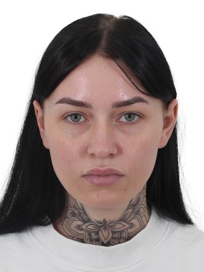 Blepharoplasty Before & After Gallery - Patient 236095 - Image 1